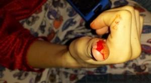 sliced-thumb-in-halloween-candy