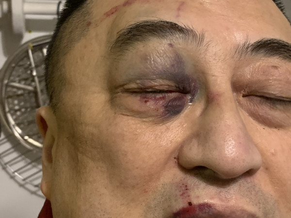 黃寧宇受傷照片。 高冰塵Twitter圖片