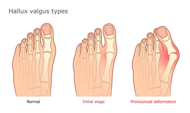 Medical vector illustration of Hallux valgus types. Healthy foot, initial stage and pronounced deformation.