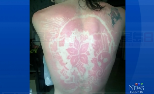 “曬傷紋身”日漸流行 醫生警告皮膚癌風險