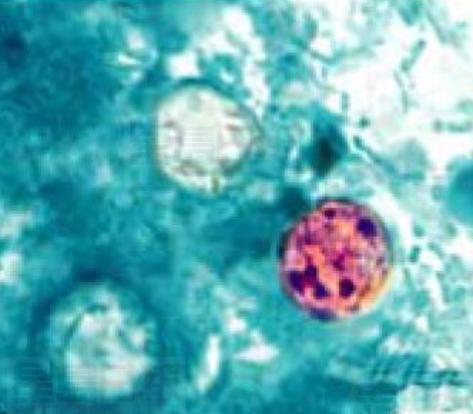 公共健康官員：環孢子蟲病爆發 安省最嚴重