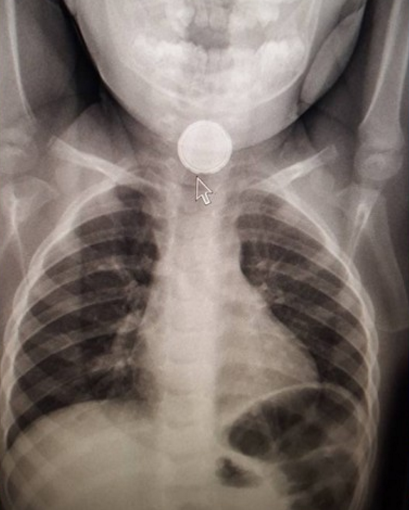 2歲女孩電池卡喉 被多名醫生診斷成流感