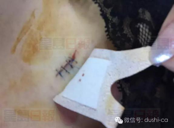 中國女留學生Yonge/Finch被搶 反抗嚴重受傷