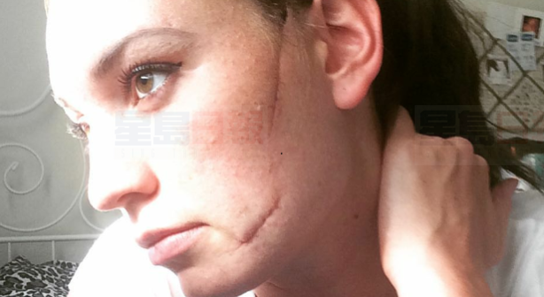 多倫多女子街頭被陌生人劃臉 媽媽們籌款相助