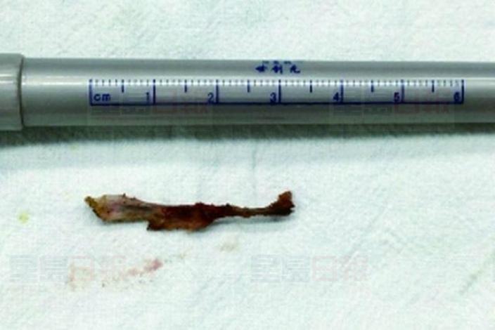 男童因病求診 竟發現腹中藏針