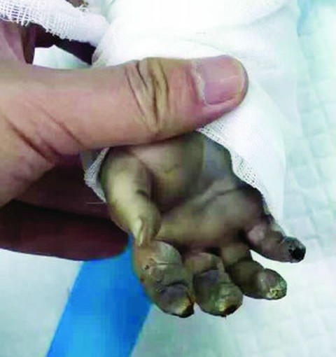 阿媽開風筒氹瞓覺 疑短路男嬰燒傷命危