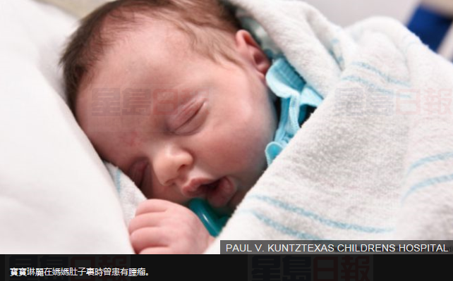 這名奇跡寶寶出生了兩次