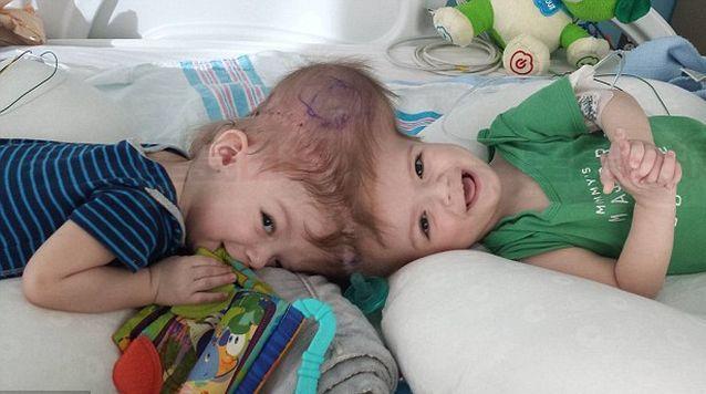 美國孖B頭相連 手術成功分割奇蹟生存