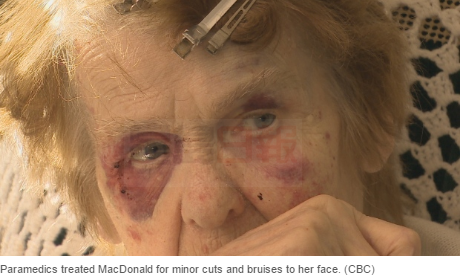 加拿大85歲老婦遇入室搶劫 被打得鼻青臉腫