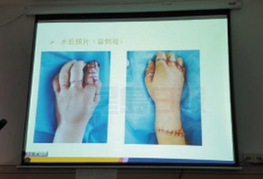 女子自殘斬斷手腕和十指 醫生3千針接回