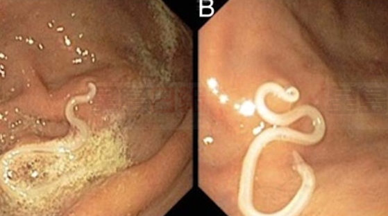 喜歡吃壽司？男子吃加拿大三文魚染寄生蟲