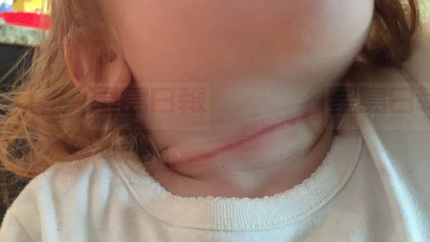 三歲女童被狗繩勒頸