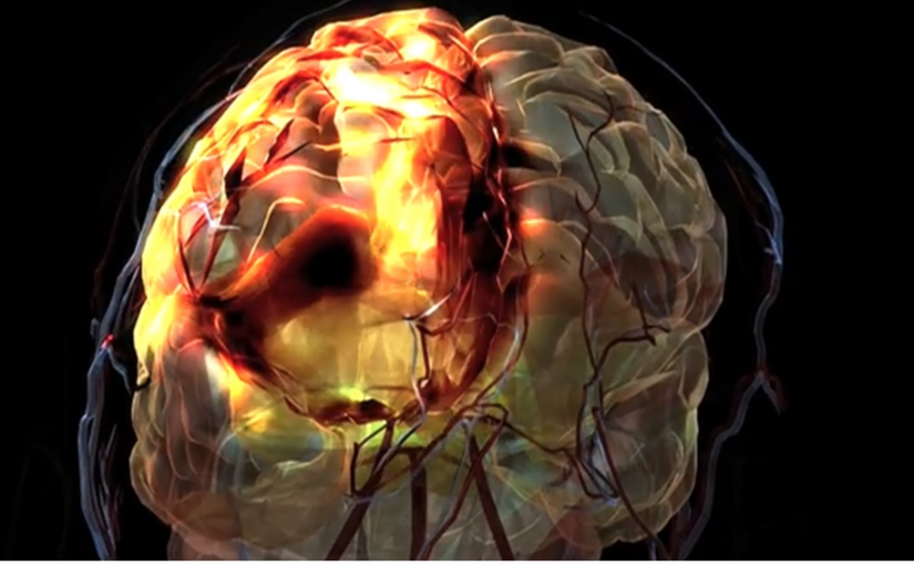 研究顯示加年輕人患中風比例增加 與生活方式有關