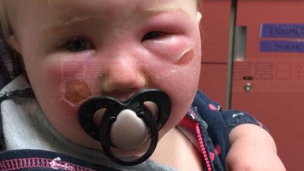 防曬霜燒傷皮膚 原來受害者遠不止兩幼童