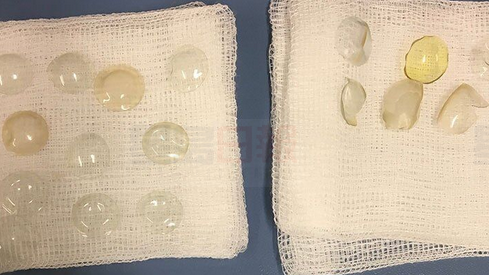 女子退休后眼中取出27個隱形眼鏡