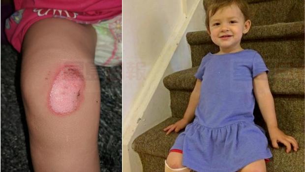 為什麼多倫多還有金屬滑梯？2歲女童被燙傷