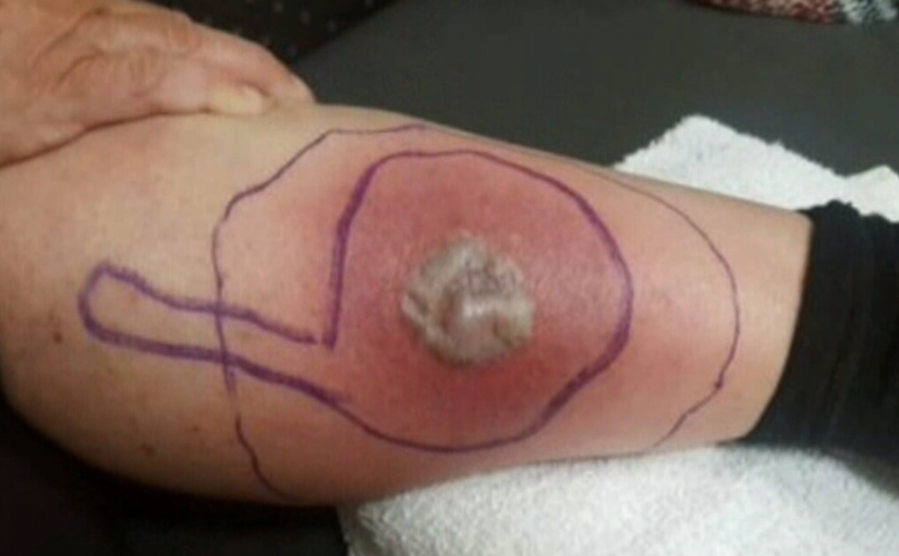 小心這種蜘蛛！可能是它把女子咬成這樣…