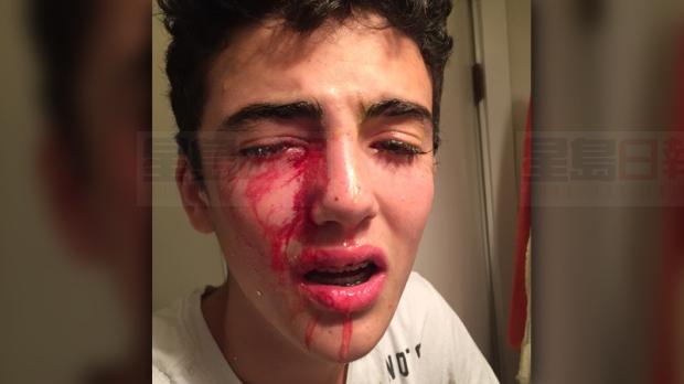 北溫男童遭擲雞蛋眼部重創 警拘4惡少