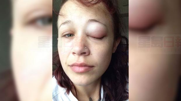 加國女子在眼球上紋身失敗 視力下降幾乎失明
