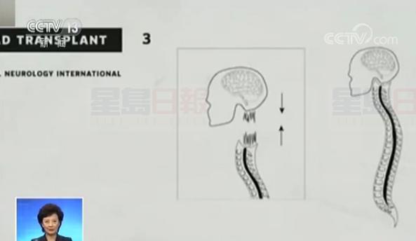 中國醫生18小時完成全球首例人類“換頭術”
