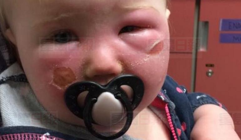 香蕉船灼傷皮膚？ 加拿大衛生部測試了27種防曬產品