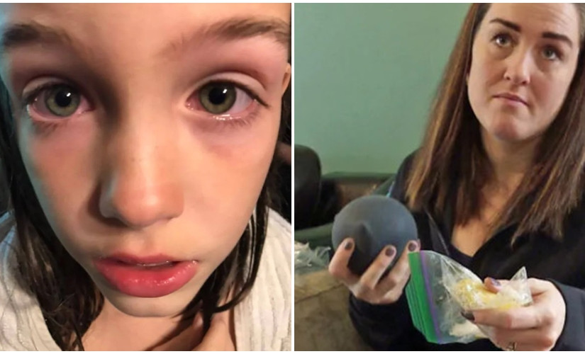 中國製玩具爆開漿液噴眼  女童眼發炎對光敏感