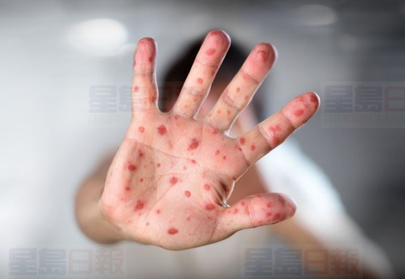 皮爾區確診1麻疹病例   曾到機場者有感染風險