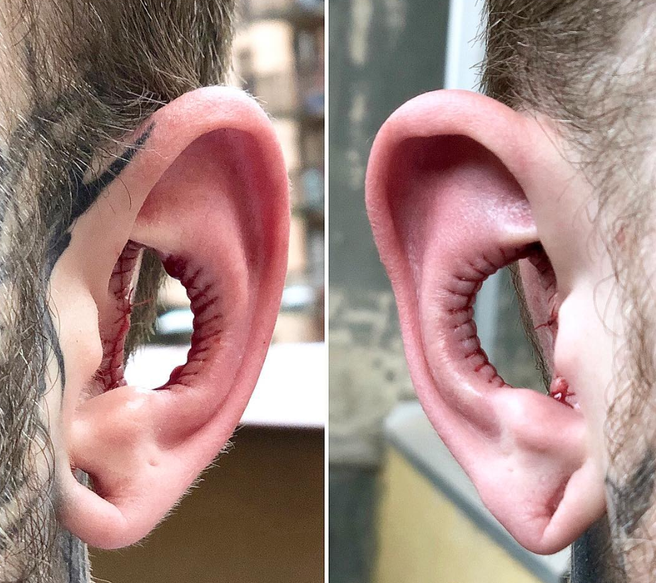 耳殼開洞為增聽力   專家不同意