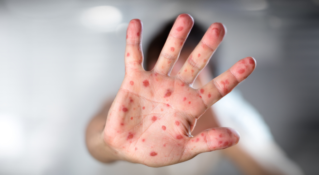 美國15州麻疹爆發 訪美加人須提防