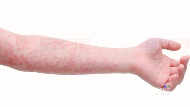 溫哥華島新增兩宗麻疹個案 令卑詩省的確診患者增至25人