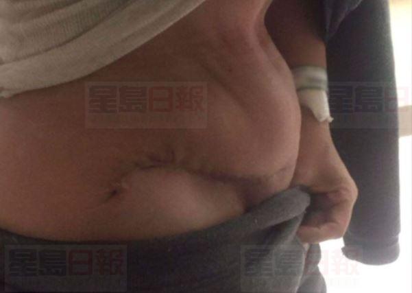 貪平到多明尼加做整形手術 最終留下終生疤痕