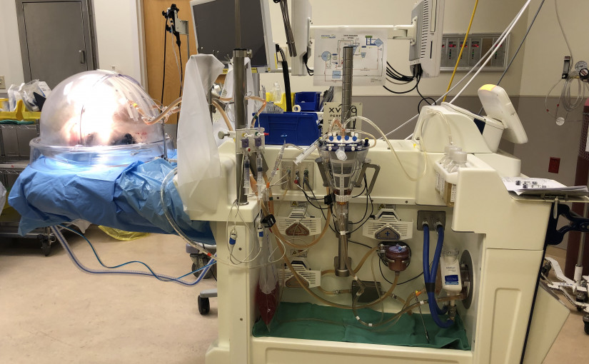 VGH引入新技術 增加可移植供肺數量