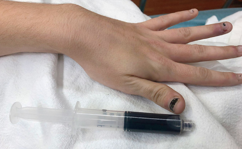 服用止痛藥變藍血人 醫生：罕見有致命危險