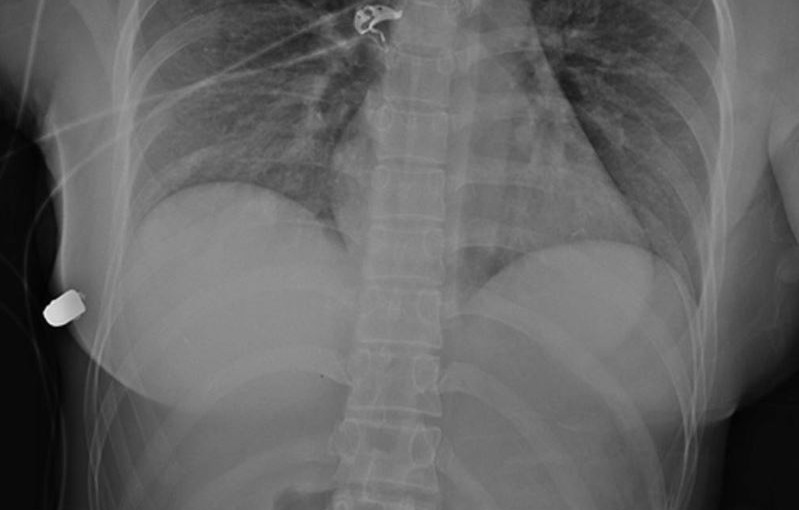 隆胸矽膠植入物轉移子彈軌跡 挽回女子生命
