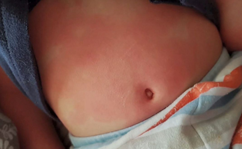 兒童出現罕見不尋常炎症 或與新冠病毒有關