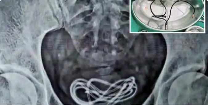 60公分電線「插尿道自慰」掉到膀胱   醫生都傻眼