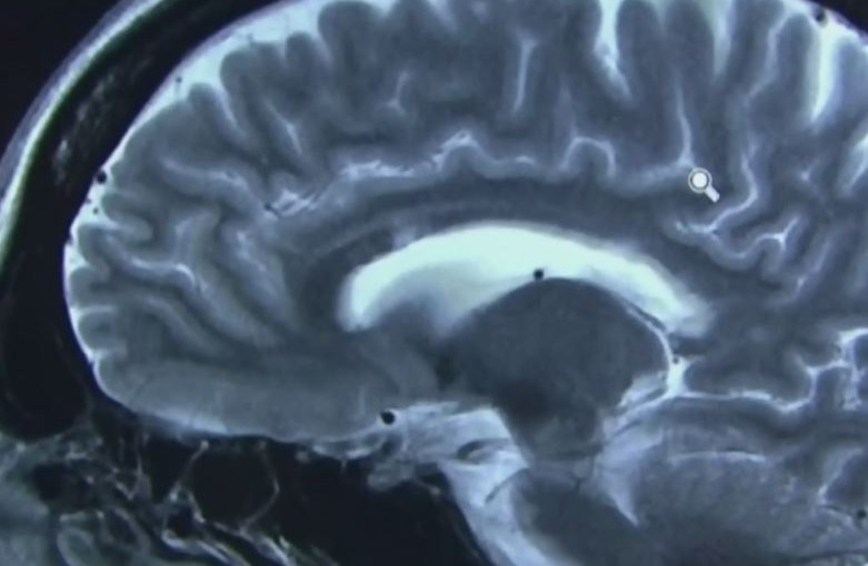 腦部受傷酗酒污染環境增患老人癡呆症 專家提9建議降風險