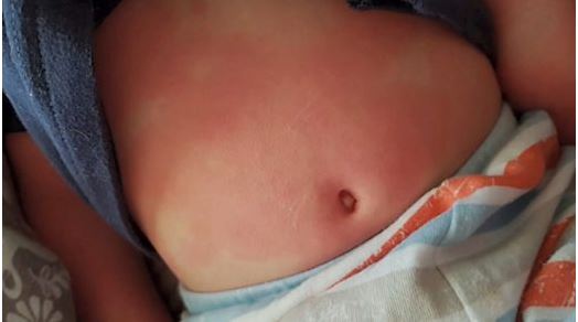 卑詩省發生第二宗兒童患上多系統炎症綜合症病例