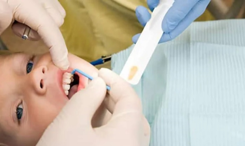 卡加利供水缺乏氟化物可導致乳齒蛀牙