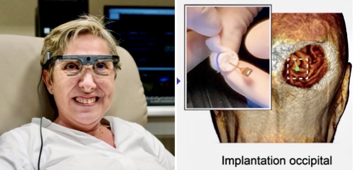 【科技生活】大腦植入電極刺激視覺 失明16年病人重見光明
