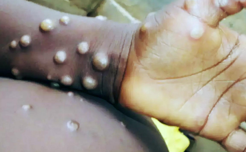 美國首名猴痘患者4月底曾到訪加拿大