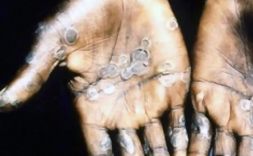 專染病專家：未來數天或數周 加國猴痘病例料續增