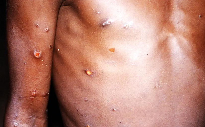 世衛：無證據證明猴痘病毒出現變異