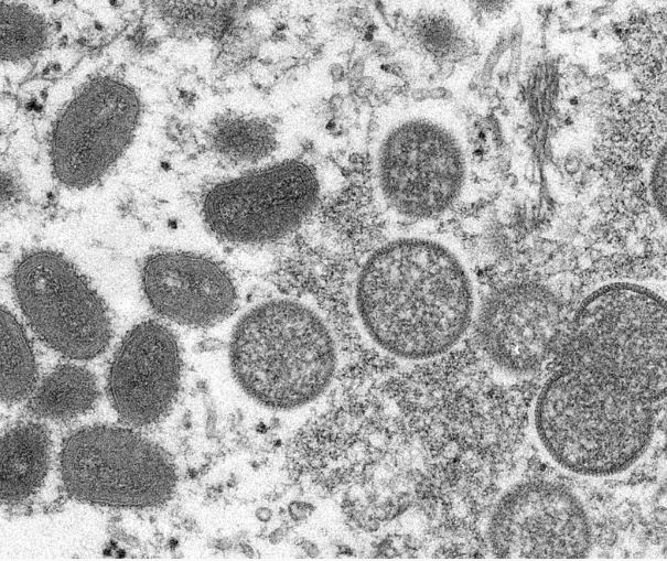出現猴痘和兒童嚴重急性肺炎挑戰 專家警告 新興病毒不可避免 要做好監測