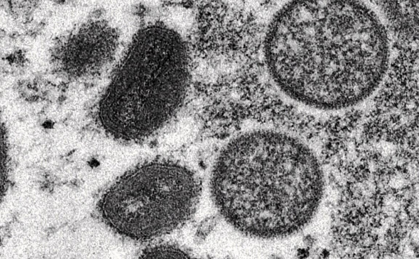 咸美頓發現首宗確診猴痘病例