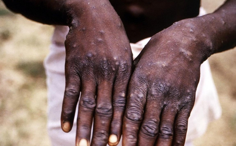 世衛數周內第2次考慮是否將猴痘列作全球危機