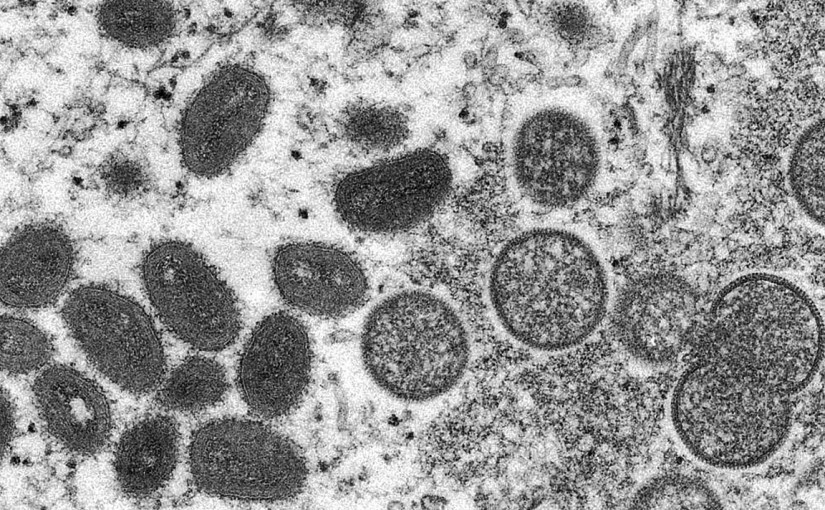 約克區首現猴痘病例 2患者無關聯