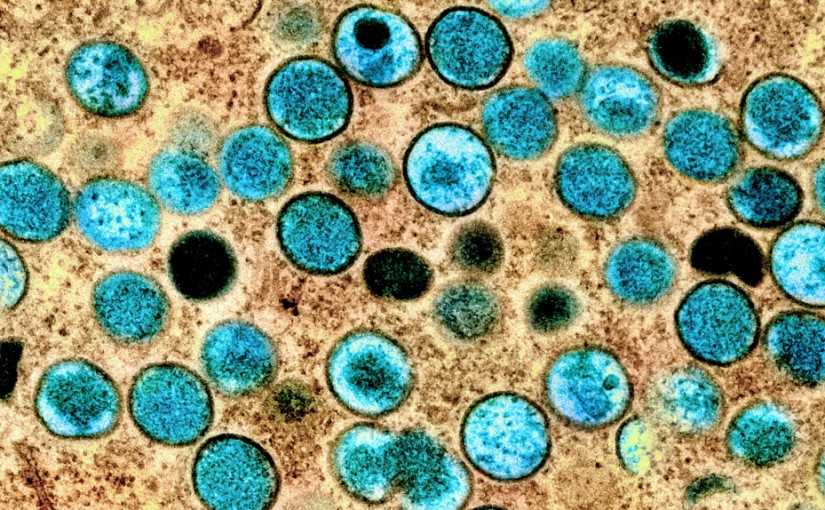 卑詩錄85宗猴痘病例  佔全國約十分一