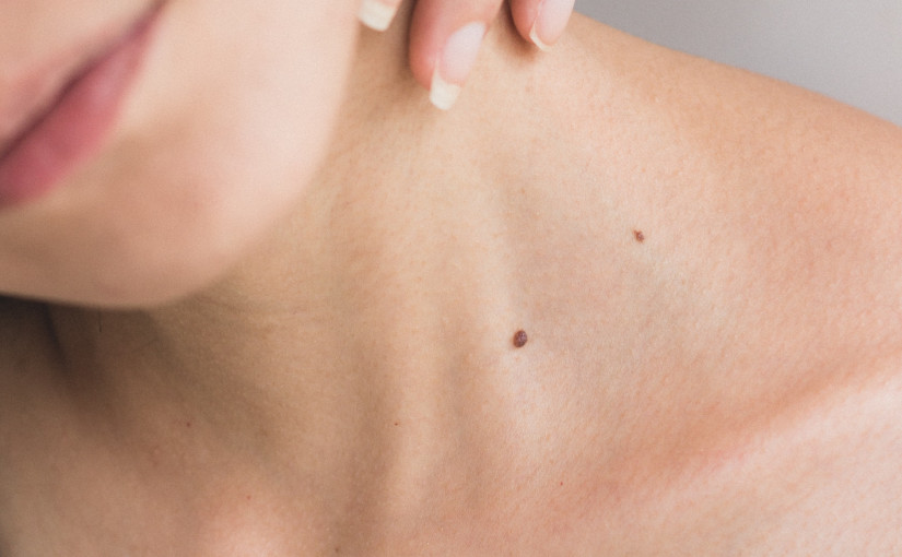 皮膚癌｜身體出現5種痣恐變癌症 醫生教自測方法：1部位最高危