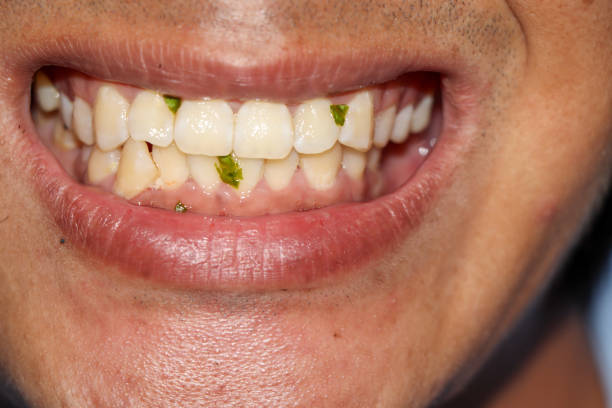 牙齒健康｜牙縫卡菜渣=患牙周病？攝牙罅恐藏4大問題須杜牙根